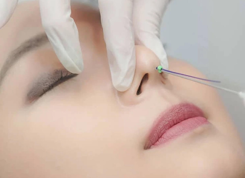 Những thông tin cần biết về nâng mũi bằng chỉ 1