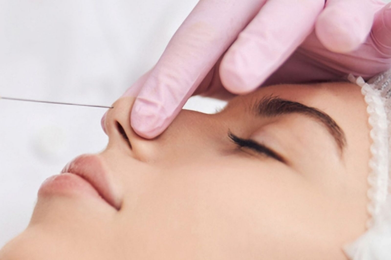 Nâng mũi bằng chỉ collagen là gì? Có tốt không và cần lưu ý những gì? 1