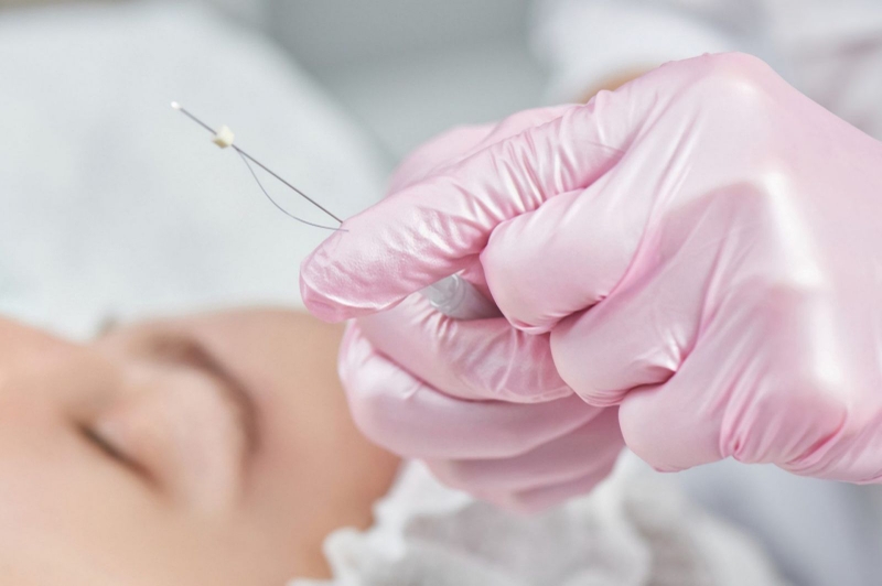 Nâng mũi bằng chỉ collagen là gì? Có tốt không và cần lưu ý những gì? 2