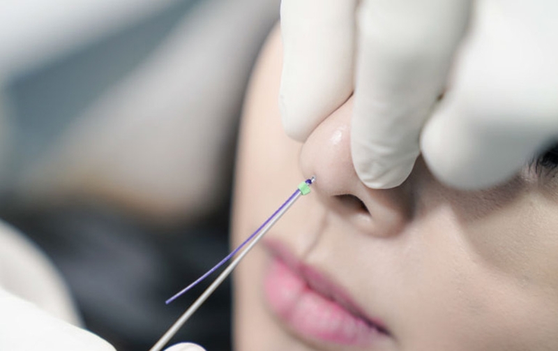 Những điều cần biết về nâng mũi bằng chỉ V- lift 3