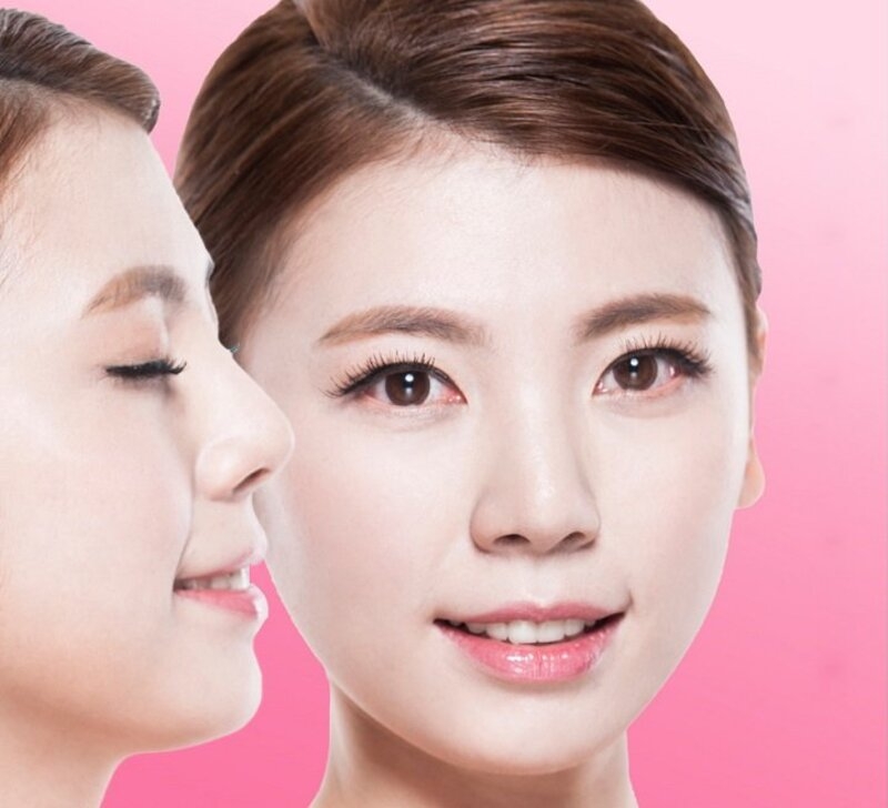 Nâng mũi bằng sụn tai có an toàn không? 1