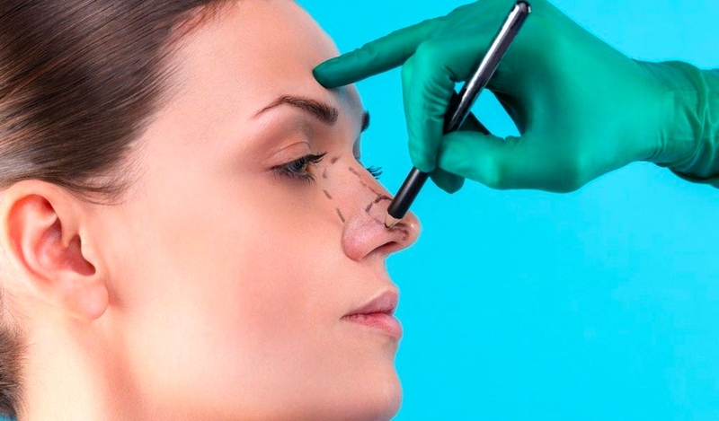 Nâng mũi bao lâu thì đầu mũi gom lại? Mẹo gom đầu mũi nhanh hơn 1