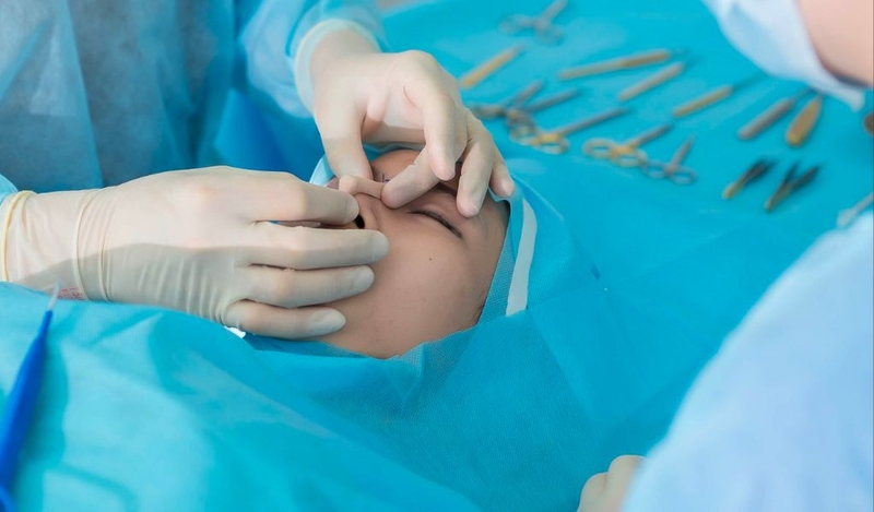 Nâng mũi bao lâu thì đầu mũi gom lại? Mẹo gom đầu mũi nhanh hơn 2