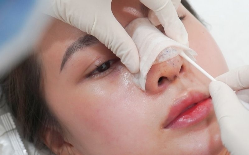 Giải đáp thắc mắc: Nâng mũi bị bao xơ là gì? 2