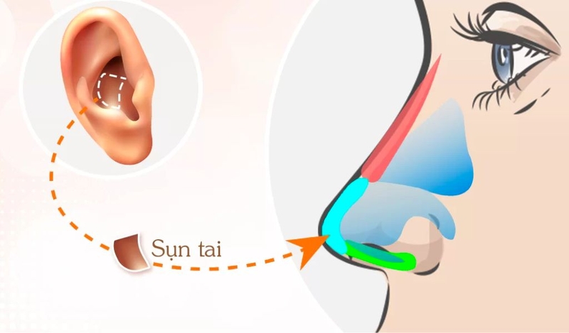 Nâng mũi bọc sụn tai có vĩnh viễn không? Có an toàn không? 1