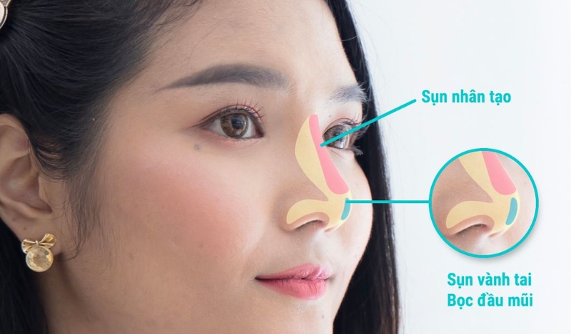 Nâng mũi bọc sụn tai có vĩnh viễn không? Có an toàn không? 2