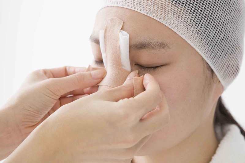 Nâng mũi cấu trúc l-line là gì? Phù hợp với những khuôn mặt nào? 3