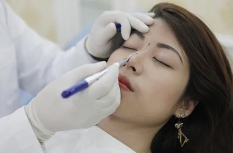 Những điều cần biết về nâng mũi bằng chỉ V- lift 2