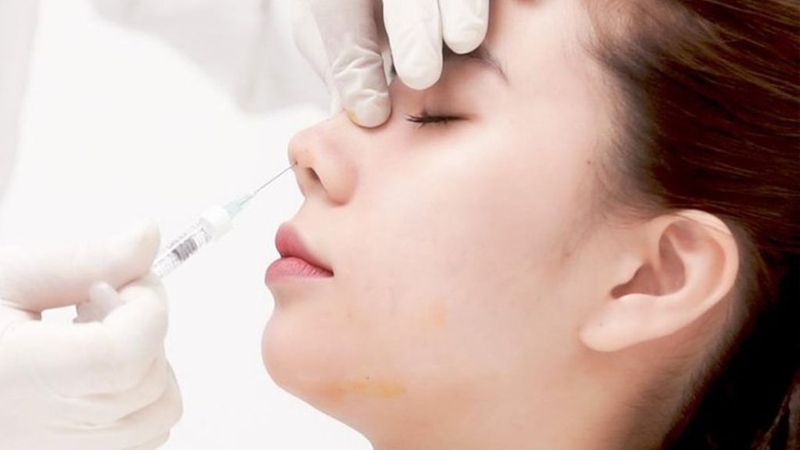 Nâng mũi chỉ hiko: Phương pháp thẩm mỹ được ưa chuộng hiện nay! 2