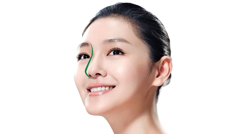 Nâng mũi chỉ tự tiêu là gì? Có hiệu quả và bền lâu không? 3