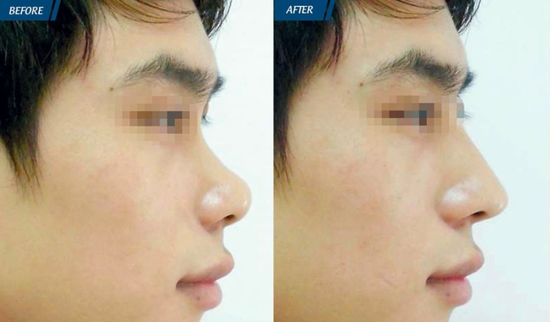 Nâng mũi L line cho nam khác nữ như thế nào? Phù hợp với đối tượng nào? 2