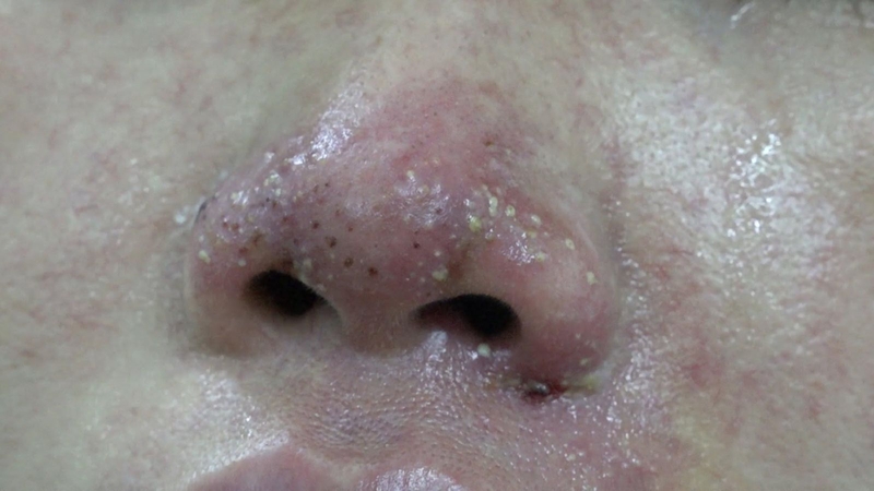 Nâng mũi là gì? Những biến chứng nâng mũi có thể gặp là gì?2