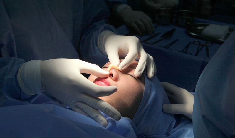 Nâng mũi sau 10 ngày hồi phục như thế nào? Lưu ý trong cách chăm sóc 1