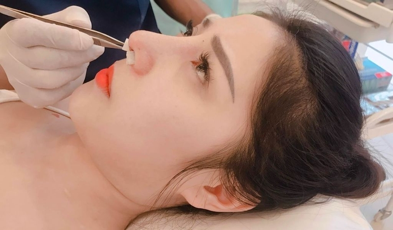 Nâng mũi siêu cấu trúc là gì? Thời gian duy trì bao lâu? 3