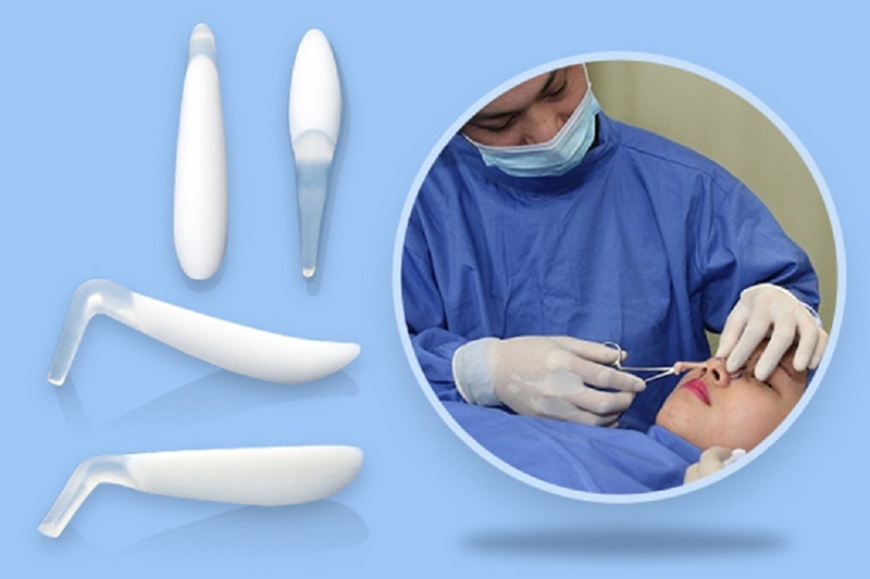 Nâng mũi sụn nhân tạo là gì? Có an toàn không 2