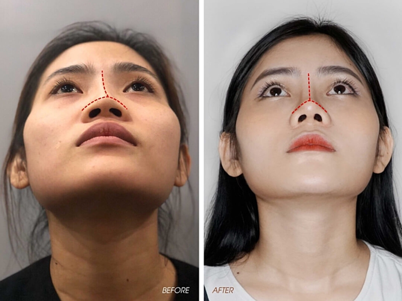 Nâng mũi sụn nhân tạo là gì? Có an toàn không 3