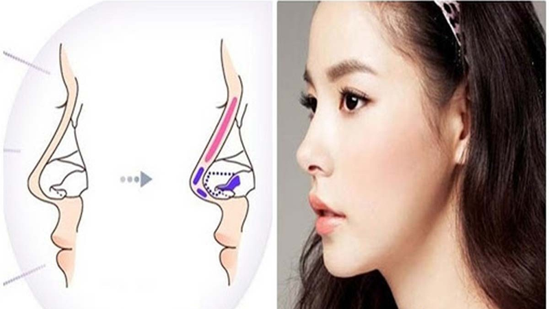 Nâng mũi sụn sườn có bị teo lại không? Nên hay không nên làm nâng mũi sụn sườn