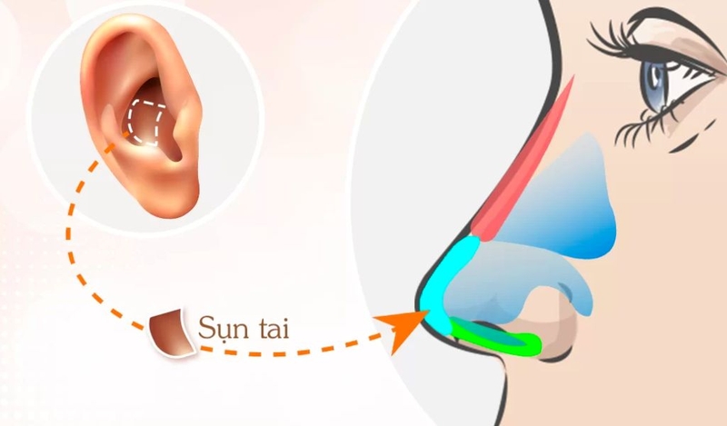 Nâng mũi sụn tai là gì? Giải đáp thắc mắc về nâng mũi bằng sụn tai 1