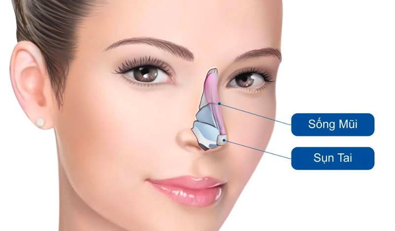 Nâng mũi sụn tai là gì? Giải đáp thắc mắc về nâng mũi bằng sụn tai 2