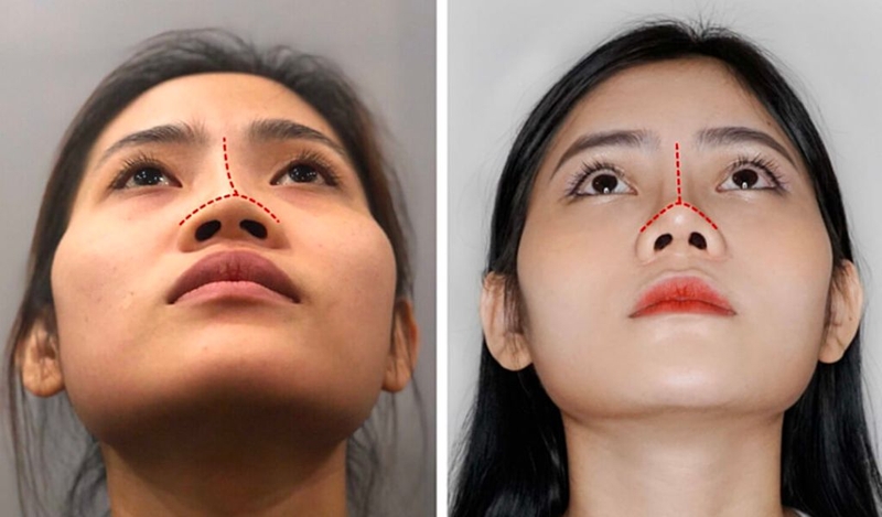 Nâng mũi sụn tai là gì? Giải đáp thắc mắc về nâng mũi bằng sụn tai 3