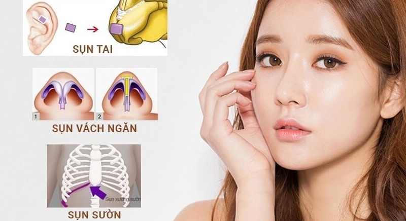 Nâng mũi sụn tự thân