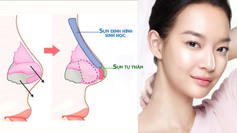 Nâng mũi sụn tự thân có an toàn không 1