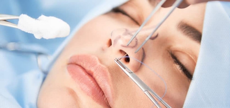 Nâng mũi tháo nẹp sớm có sao không? Sau bao lâu có thể tháo băng nẹp? 1