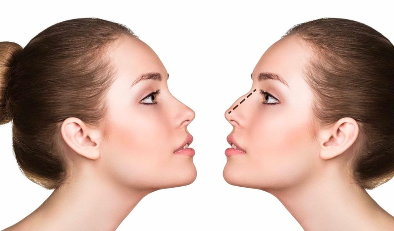 Nâng mũi tháo nẹp sớm có sao không? Sau bao lâu có thể tháo băng nẹp? 3