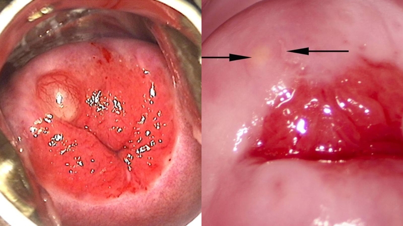 Nang naboth cổ tử cung 4mm có mang thai được không 1