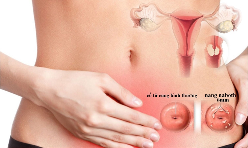 Nang naboth cổ tử cung 8mm có nguy hiểm không 1