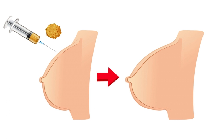 Tìm hiểu về phương pháp nâng ngực bằng tế bào gốc từ máu 4
