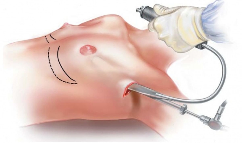 Quy trình nâng ngực đúng chuẩn