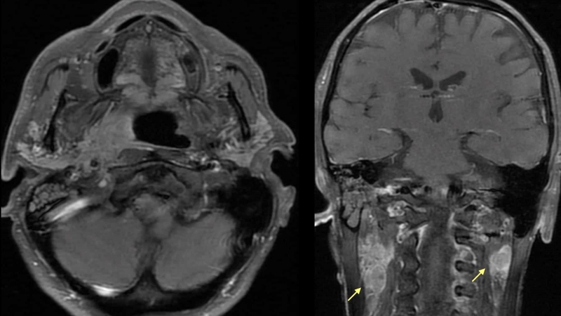 nang-nhai-san-mieng-trieu-chung-va-cach-dieu-tri 2