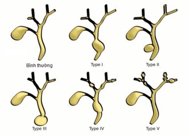 Nang ống mật chủ là gì? Phương pháp điều trị nang ống mật chủ 1