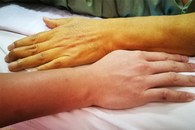 Nang ống mật chủ là gì? Phương pháp điều trị nang ống mật chủ 2