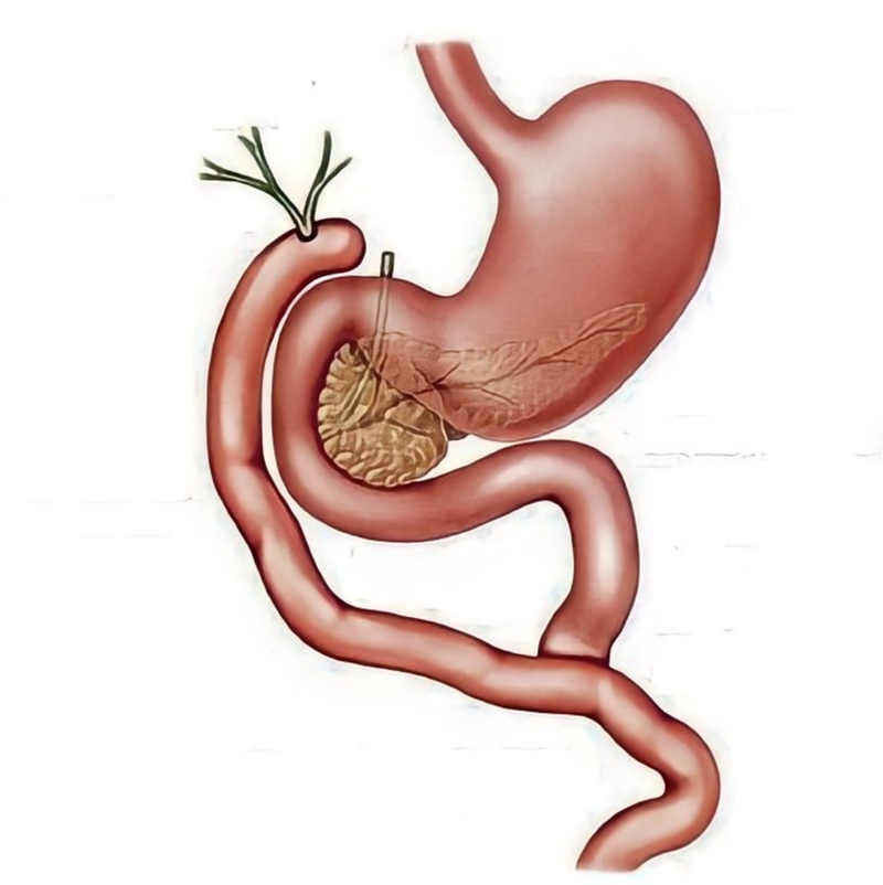 Nang ống mật chủ là gì? Phương pháp điều trị nang ống mật chủ 3