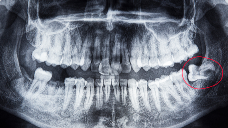 Nang thân răng: Nguyên nhân, triệu chứng và hướng điều trị hiệu quả 4