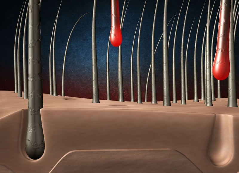 Nang tóc là gì? Nguyên nhân nang tóc chết và cách khắc phục 1