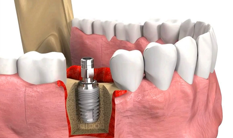 Nâng xoang hở trong cấy ghép Implant có đau không? 1