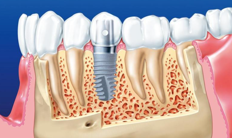 Nâng xoang hở trong cấy ghép Implant có đau không? 2