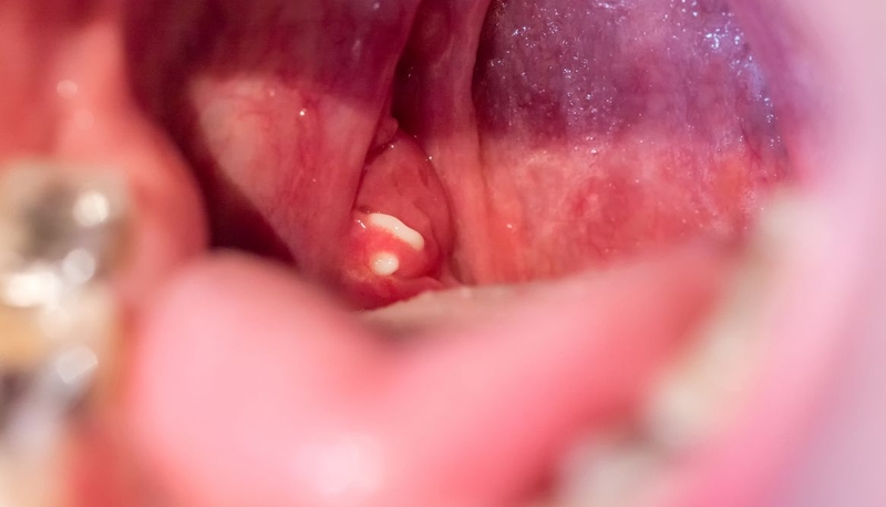 Nạo VA bao nhiêu tiền? Khi nào cần nạo VA 1