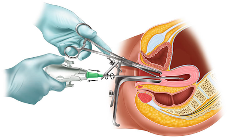 Nạo hút thai có đau không? Những lưu ý sau khi nạo phá thai 1