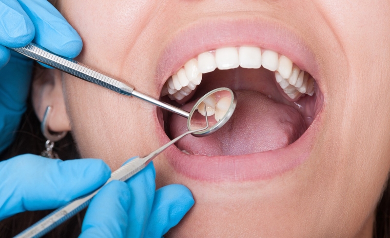 Nạo túi nha chu - Giải pháp hiệu quả cho sức khỏe răng miệng 2