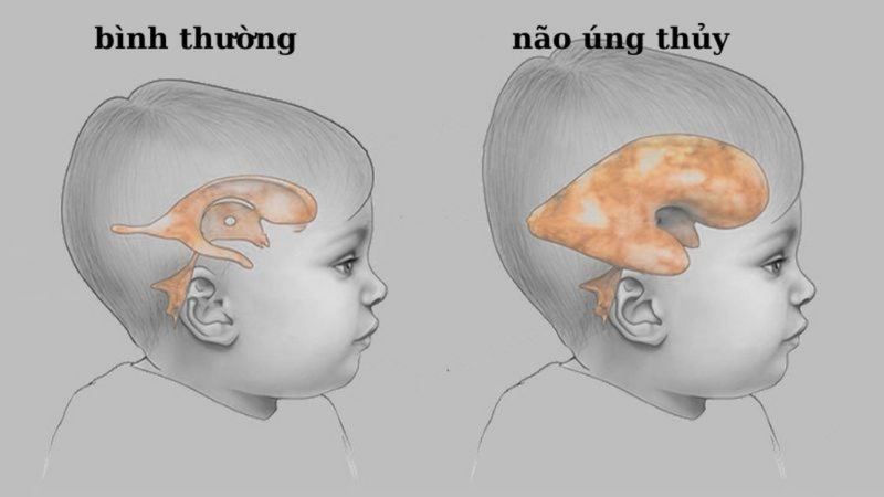 Não úng thủy bẩm sinh: Nguyên nhân, triệu chứng và phương pháp điều trị 1