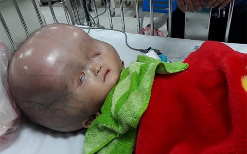 Não úng thủy bẩm sinh: Nguyên nhân, triệu chứng và phương pháp điều trị 3