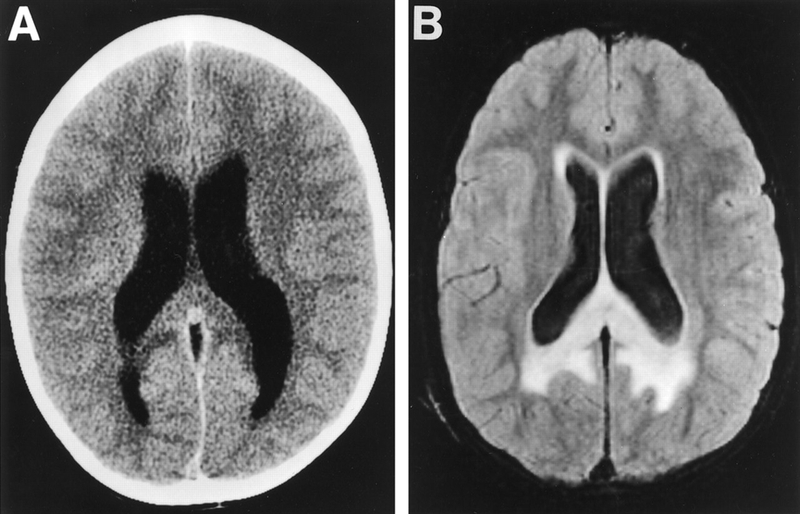 Não úng thủy là bệnh gì? Nguyên nhân và cách điều trị não úng thủy 4