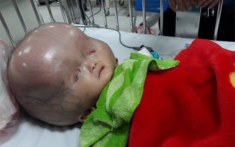 Não úng thủy ở trẻ em là gì? Não úng thủy có chữa được không? Cách phòng tránh não úng thủy 1