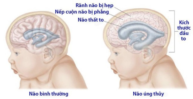 Não úng thủy là gì? Nhận biết sớm dấu hiệu não úng thủy ở trẻ em 1