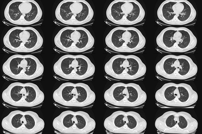 Nên chụp CT phổi vào lúc nào? Chụp CT phổi giá bao nhiêu? 2