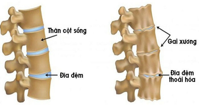 Nên chụp X quang gai cột sống khi nào và phải chuẩn bị những gì 2